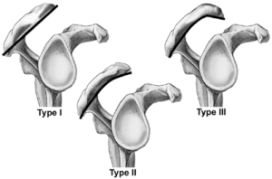 acromion types